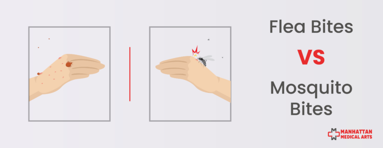 Flea Bites vs Mosquito Bites What's the Difference